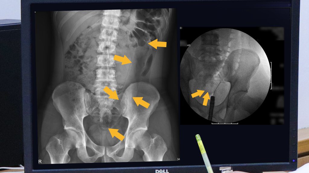 男下腹劇痛!35公分按摩棒「深入體內」 羅東博愛醫這招免開刀 男下腹劇痛!35公分按摩棒「深入體內」 羅東博愛醫這招免開刀