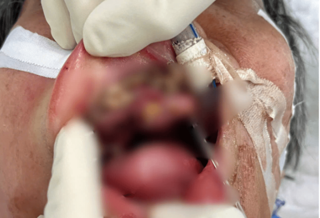 影／恐怖慎入！69歲女呼吸困難送醫　醫從口腔取出100隻蛆蟲