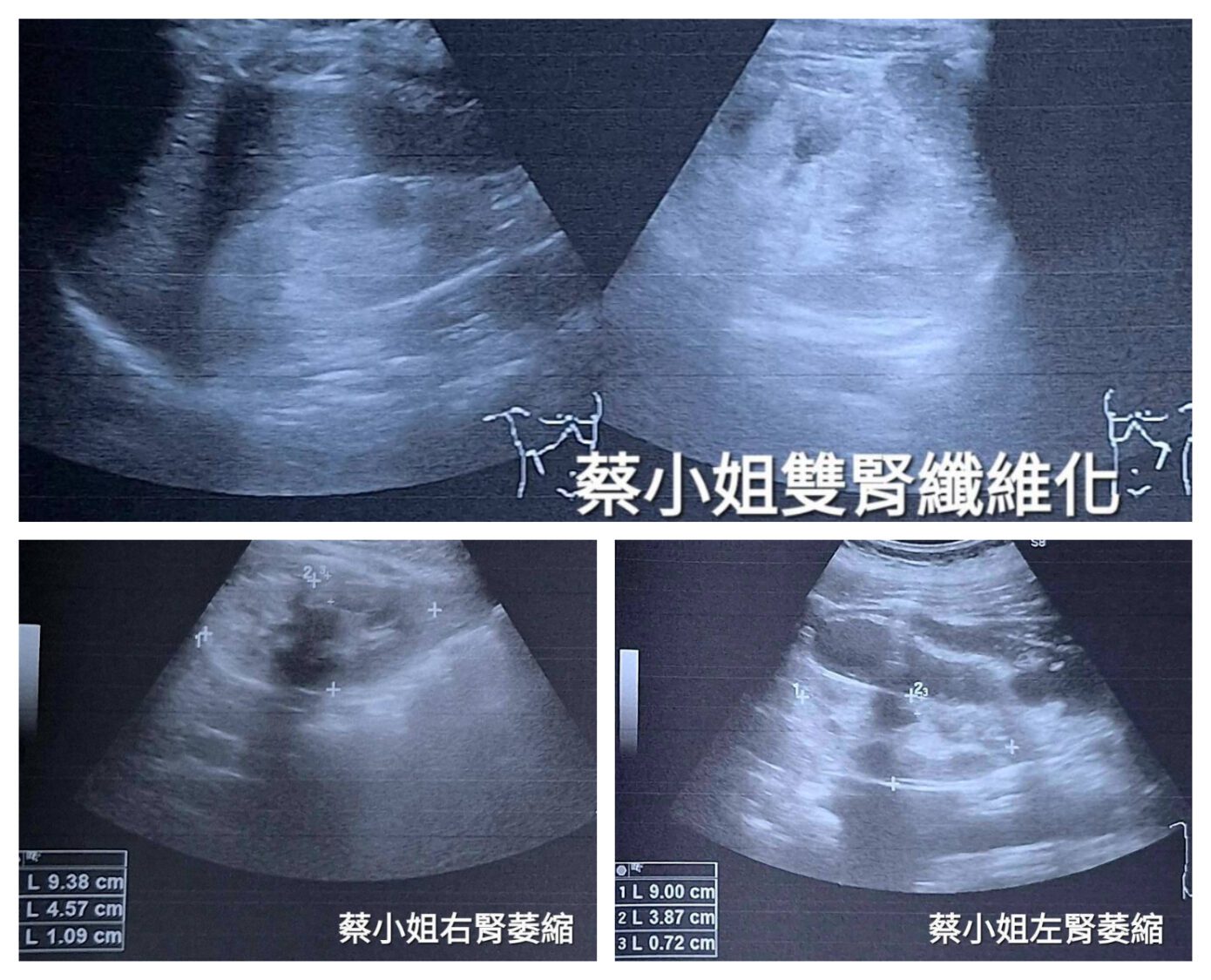 28歲女忙夜班漏服藥 阮綜合醫師林正浩:糖尿病患加速尿毒洗腎風險 28歲女忙夜班漏服藥 阮綜合醫師林正浩:糖尿病患加速尿毒洗腎風險