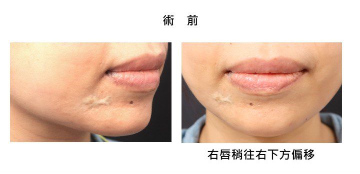 「國際白疤中心」曹賜斌醫師妙手醫治 青春凸白疤痕不再是惡夢