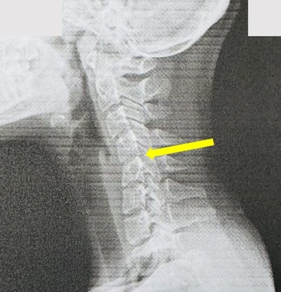 20歲女大生長期滑手機，頸椎提早老化 宛如60歲老人