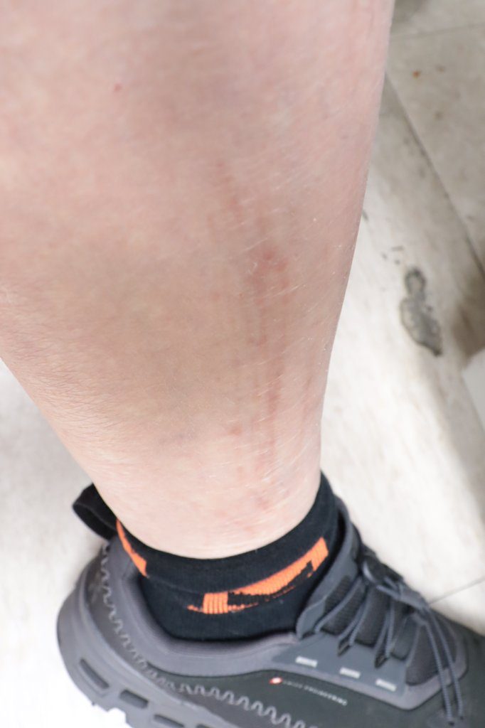 全身痛又癢 部立彰化醫院揪出副甲狀腺亢進作怪