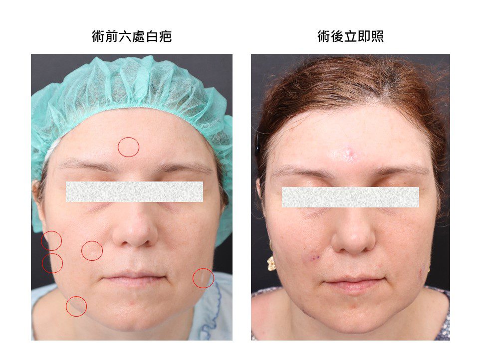 首位俄羅斯籍白疤患者慕名來台求治 國際白疤中心聲名遠播 寫下國際新里程碑