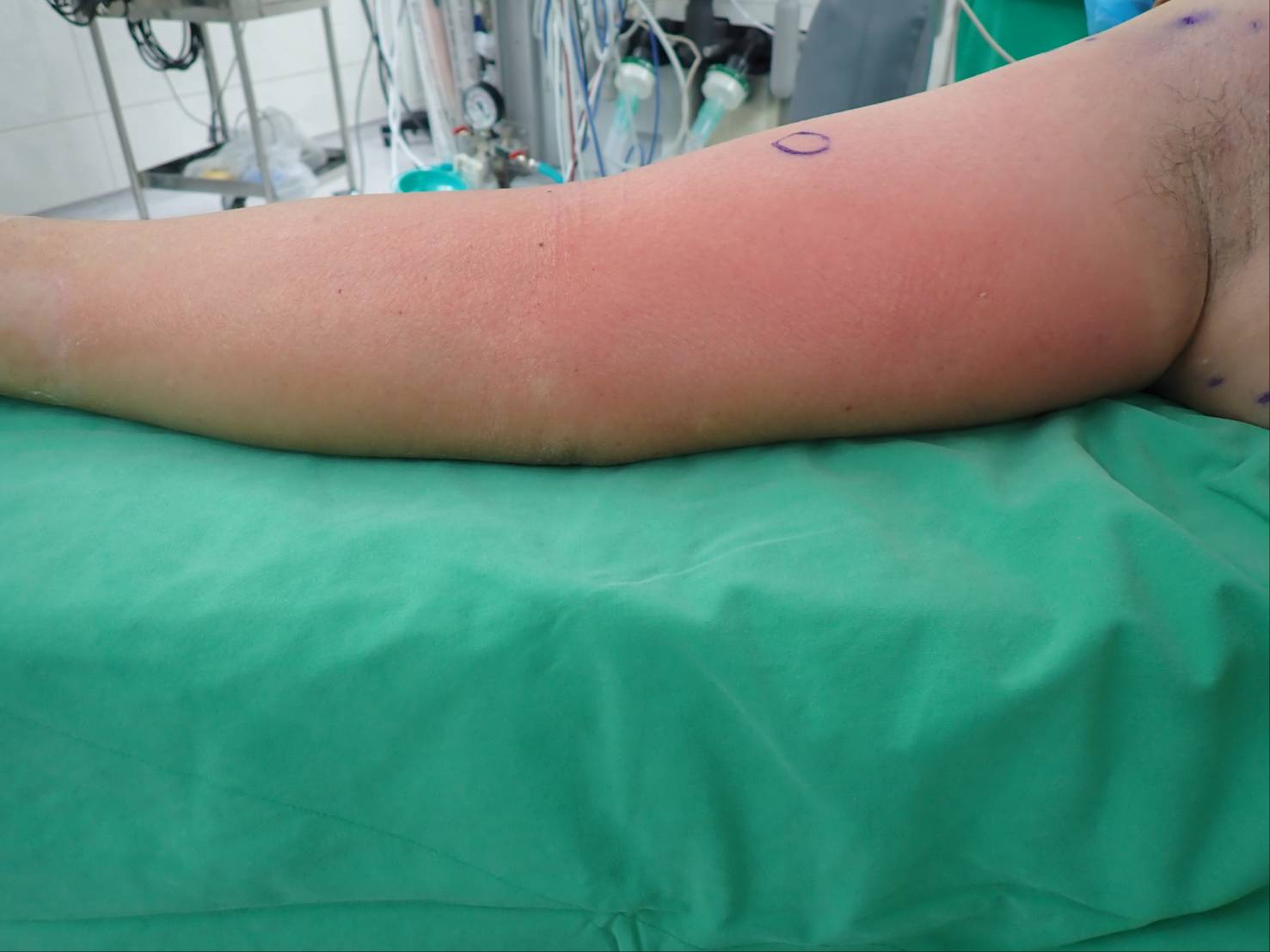 魚刺傷右手腫了2倍大 高雄秀傳及時救治讓患者免於截肢 魚刺傷右手腫了2倍大 高雄秀傳及時救治讓患者免於截肢