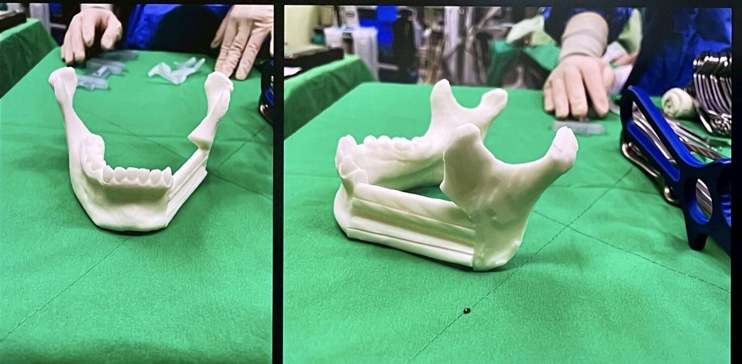 18歲少女罹患罕見顎骨腫瘤 彰化秀傳3D列印重建手術助重拾笑容 18歲少女罹患罕見顎骨腫瘤 彰化秀傳3D列印重建手術助重拾笑容