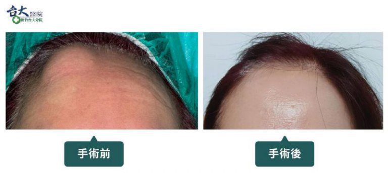 額頭硬塊竟是「額部骨瘤」　新竹臺大分院微創手術助病人改善外觀