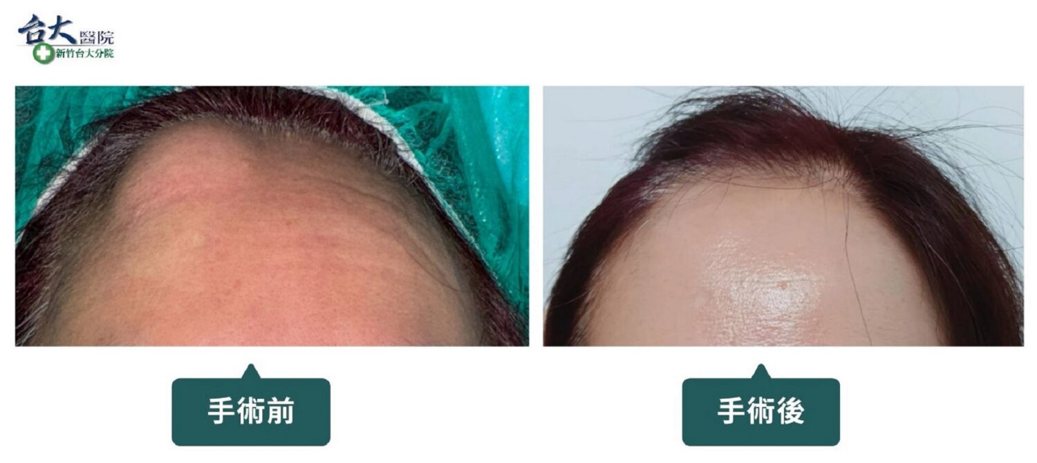 額頭或臉部有異常硬塊 醫:不論是否伴隨疼痛,都應盡早就醫! 額頭或臉部有異常硬塊 醫:不論是否伴隨疼痛,都應盡早就醫!