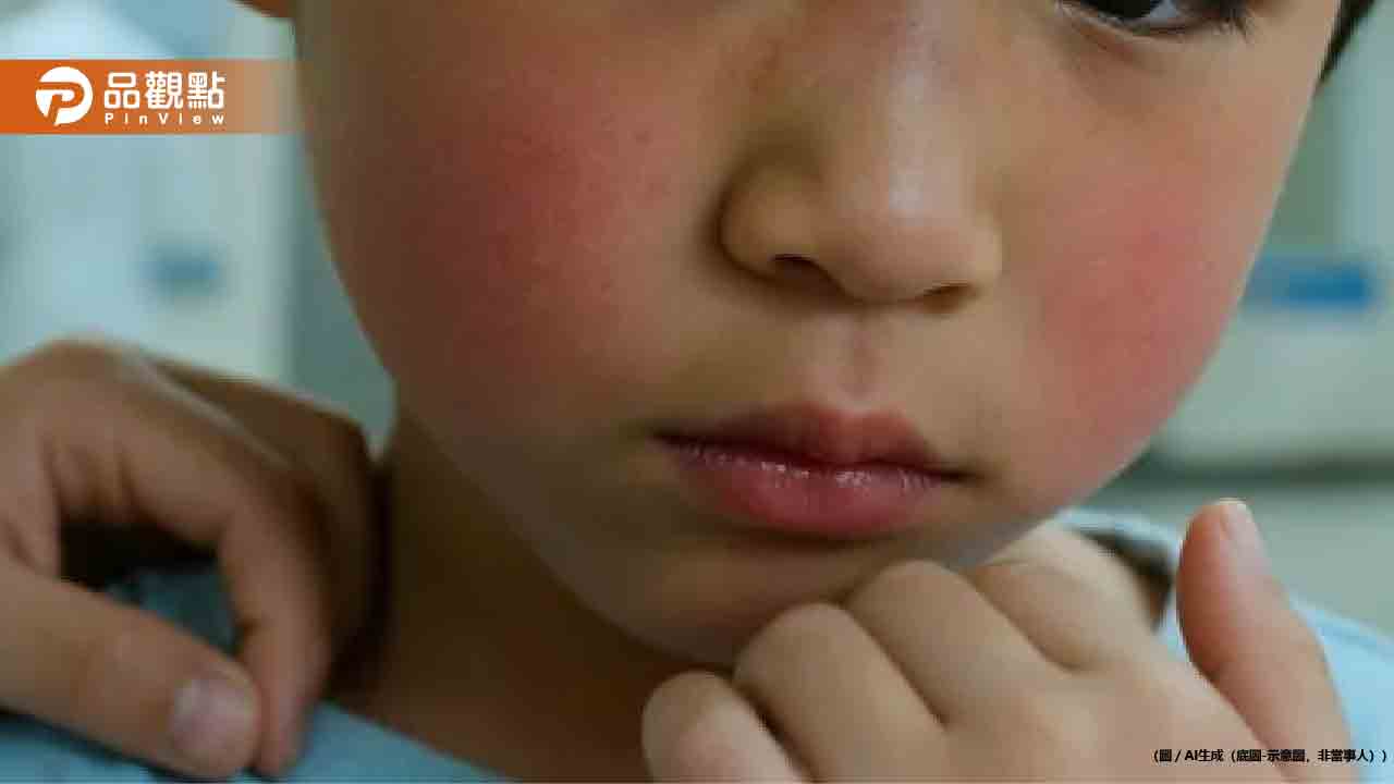 日本爆發蘋果病!5歲童遊日返台「臉頰紅如巴掌印」 日本爆發蘋果病!5歲童遊日返台「臉頰紅如巴掌印」