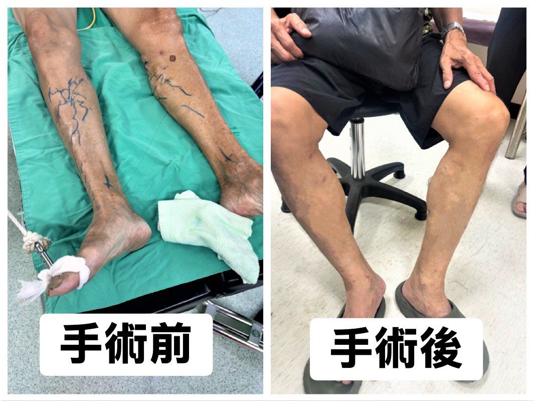 雷射手術治療靜脈曲張　術後疼痛少、恢復快、不留疤痕