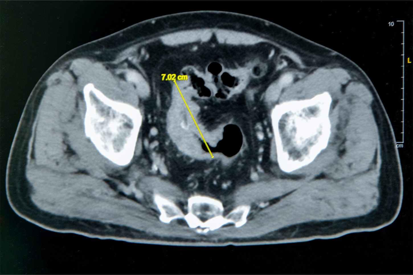 雲林七旬翁便秘竟是7公分大腸癌　彰基單孔達文西SP手術助順利除癌