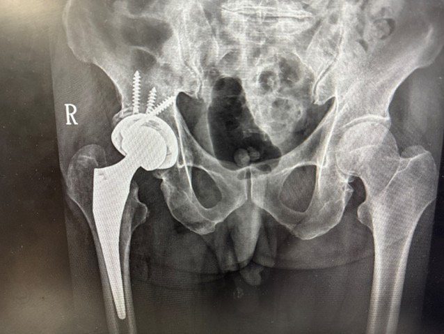 DAA微創髖關節手術　助病人快速恢復行動力