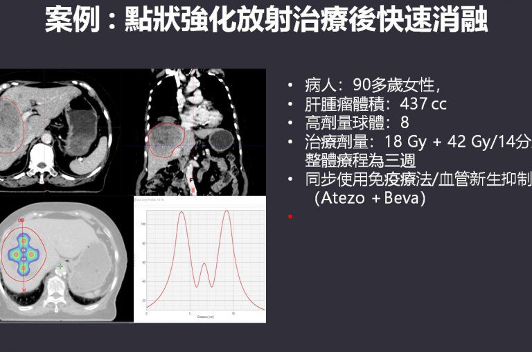 精準放療助攻 高雄榮總挑戰高難度腫瘤再創新局 精準放療助攻 高雄榮總挑戰高難度腫瘤再創新局